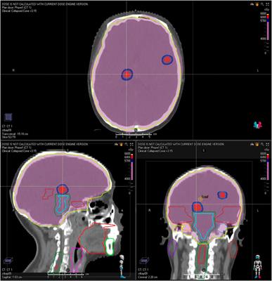 Case report: outcome of anlotinib treatment in breast cancer patient with brain metastases